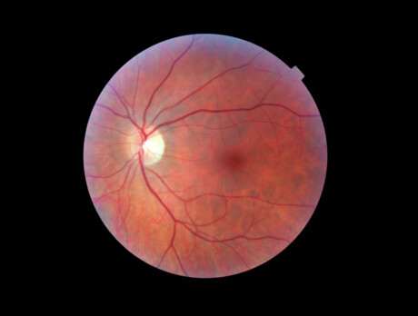 Gene therapy trial results in significant vision improvements Gene therapy trial results in significant vision improvements