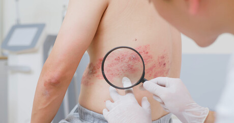 More Australians now eligible for free shingles vaccine