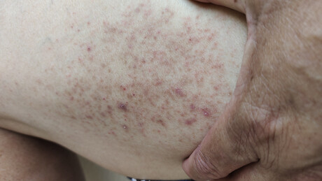 Financial stress and bariatric surgeries raise the risk of scurvy