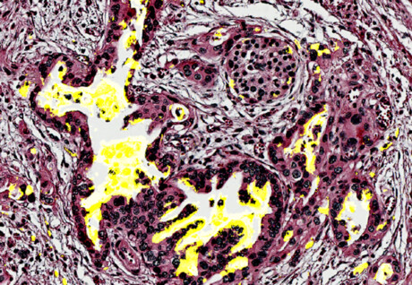 Experimental blood test detects early-stage pancreatic cancer Experimental blood test detects early-stage pancreatic cancer