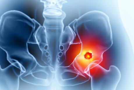 Cancer drug eliminates bone metastasis in lab models