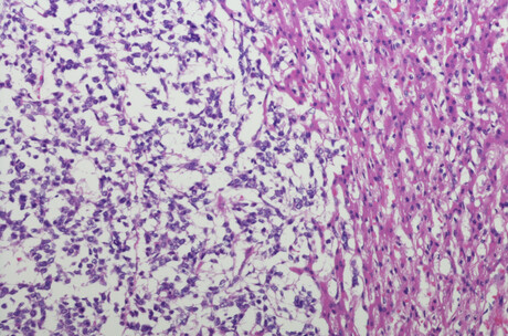 Drug delays tumour growth in models of children&#39;s liver cancer