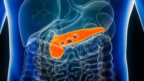 Blood test for pancreatic cancer undergoes evaluation