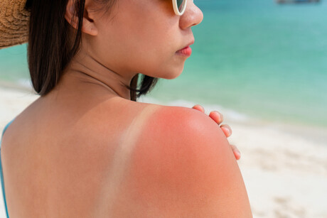 Damaged RNA, not DNA, revealed as main cause of acute sunburn Damaged RNA, not DNA, revealed as main cause of acute sunburn