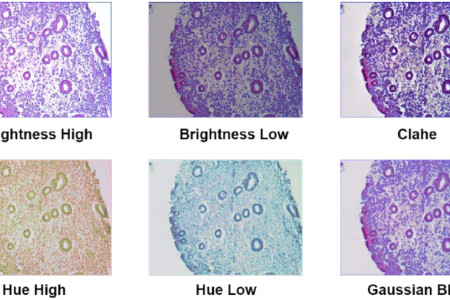 AI diagnoses endometrial cancer with high accuracy