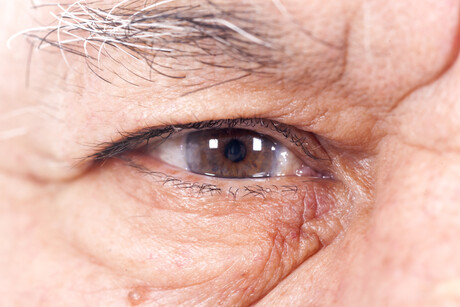 Retinal health linked to dementia risk, study shows