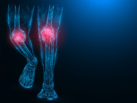 Osteoarthritis study uncovers new genetic links, drug targets