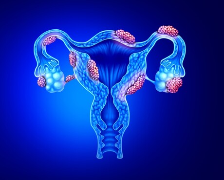 $50m donation for new endometriosis research institute