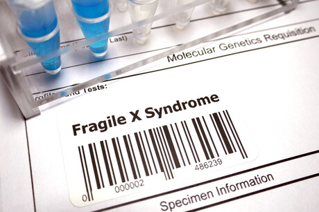Sequencing assay screens carriers of fragile X syndrome