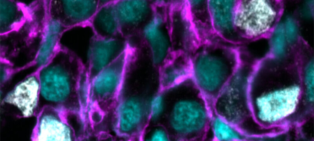 Genetic weak spot found in hard-to-treat cancers