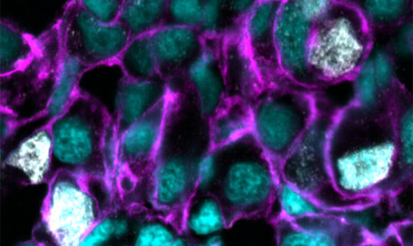 Genetic weak spot found in hard-to-treat cancers