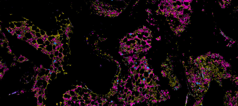 Could this bone marrow map redefine understandings of blood cancer?
