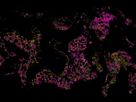 Could this bone marrow map redefine understandings of blood cancer?