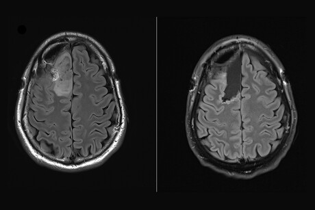 Perioperative trial offers insights into brain cancer treatment Perioperative trial offers insights into brain cancer treatment