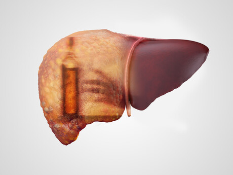 Blood test detects alcohol use in people with liver disease