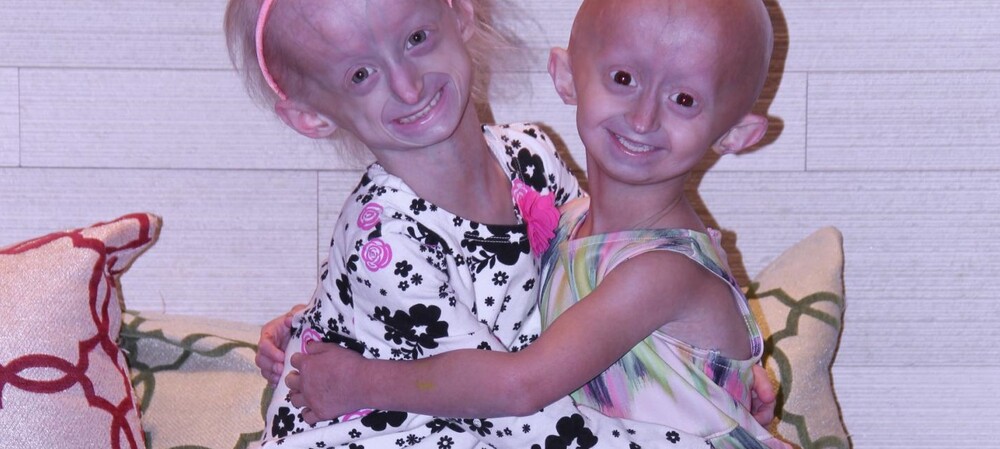 &#39;Longevity gene&#39; could reverse damage from rapid aging disease