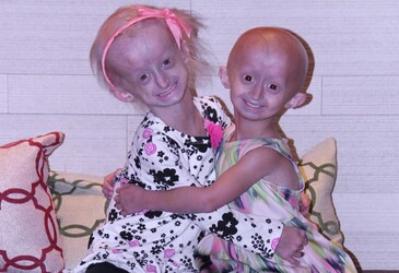 &#39;Longevity gene&#39; could reverse damage from rapid aging disease