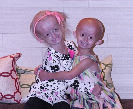 &#39;Longevity gene&#39; could reverse damage from rapid aging disease