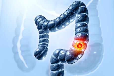 Colon cancer DNA in blood can guide chemo decisions