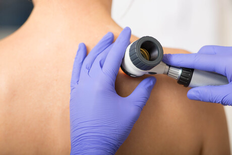 Melanoma-causing mutation can lie dormant in healthy skin