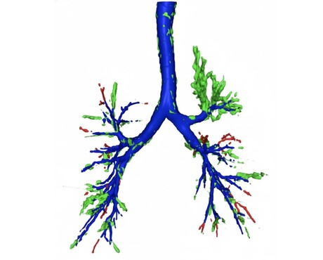 AI spots hidden objects in chest scans