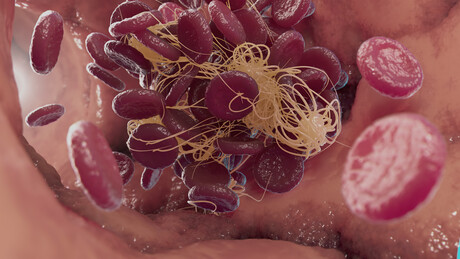 Proteomic approach identifies new blood-clotting disorder