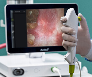 Ambu aScope 5 Uretero single-use scopes