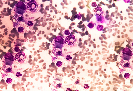 CTA granted for CAR-T cell therapy for multiple myeloma