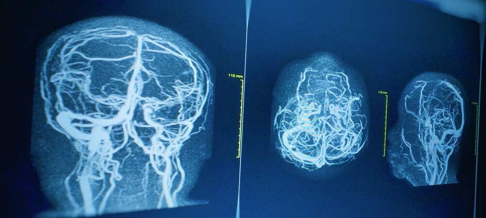 Potential biological targets for vascular dementia