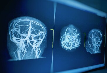 Potential biological targets for vascular dementia