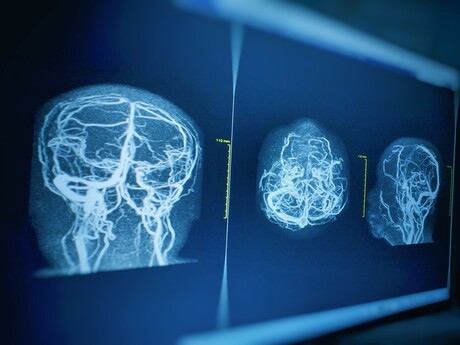 Potential biological targets for vascular dementia