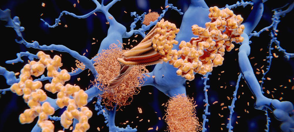 Copper drug clears Alzheimer's proteins &mdash; lab experiments reveal