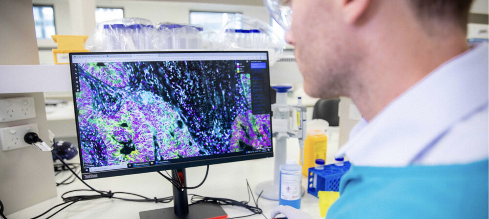 Could this human tissue biobank find the cause of a bowel cancer surge?