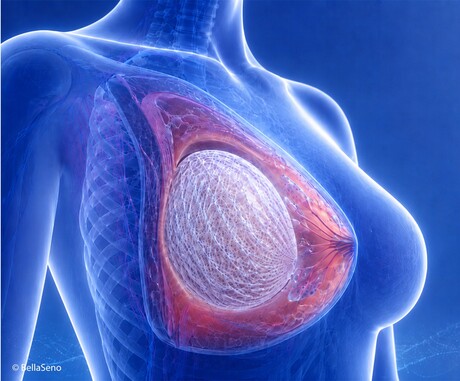 Breast augmentation procedure uses 3D-printed scaffolds