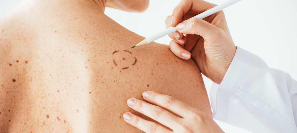 mRNA therapy found to prevent recurrence of melanoma