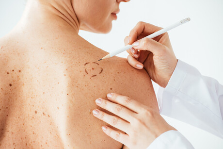 mRNA therapy found to prevent recurrence of melanoma