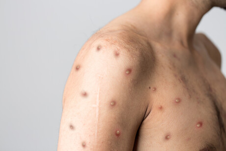 The cause of 2022's mpox outbreak revealed